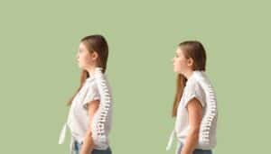 Double exposition d'une femme avec une illustration de colonne vertébrale pour illustrer la posture et la perte de poids - Catlion